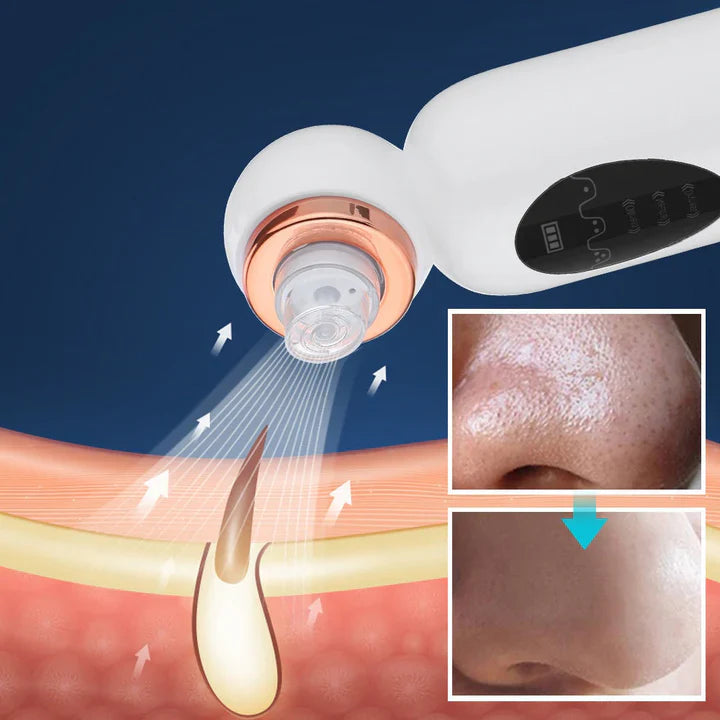 Aparato Eliminador de Espinillas e Hidrodermoabrasión Preparado para la Limpieza de Espinillas