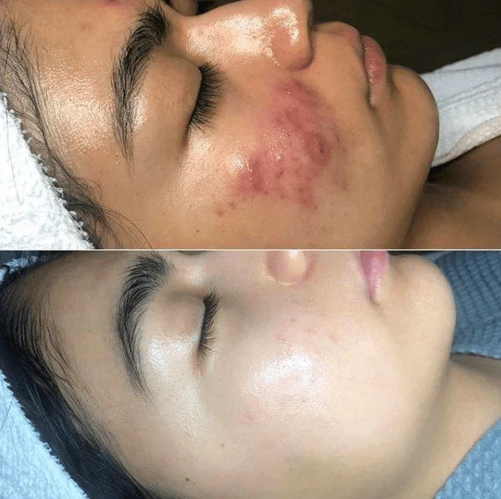 Dispositivo de Terapia Cutánea de Alta Frecuencia